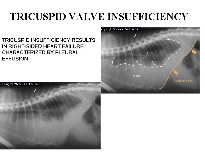 TRICUSPID VALVE INSUFFICIENCY TRICUSPID INSUFFICIENCY RESULTS IN RIGHT-SIDED HEART FAILURE CHARACTERIZED BY PLEURAL EFFUSION