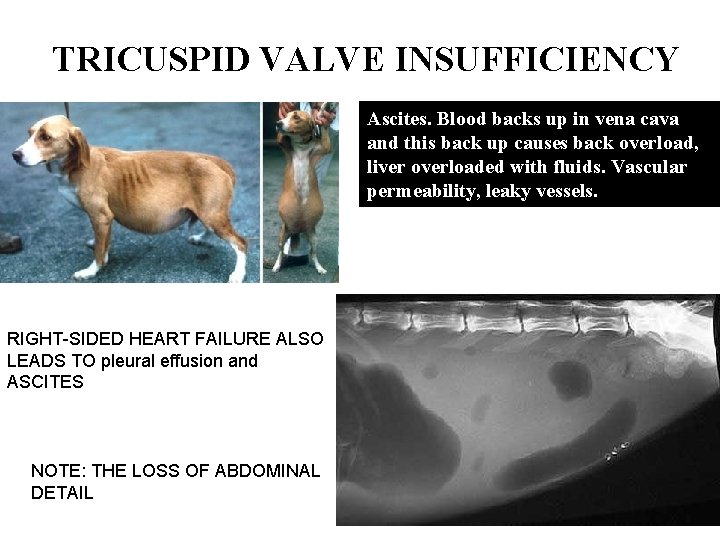 TRICUSPID VALVE INSUFFICIENCY Ascites. Blood backs up in vena cava and this back up