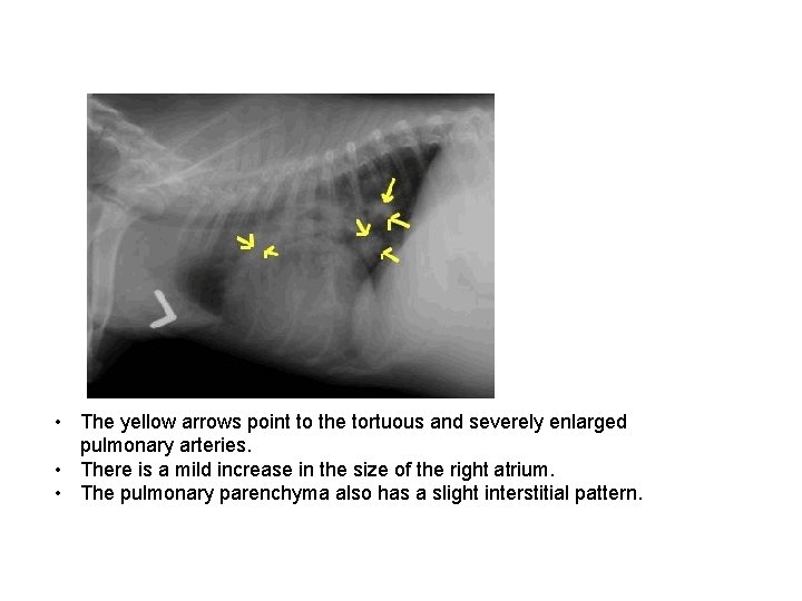  • The yellow arrows point to the tortuous and severely enlarged pulmonary arteries.