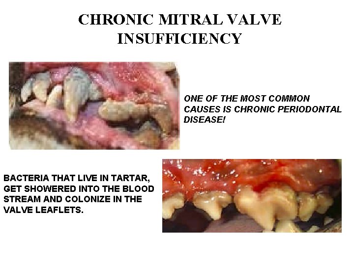 CHRONIC MITRAL VALVE INSUFFICIENCY ONE OF THE MOST COMMON CAUSES IS CHRONIC PERIODONTAL DISEASE!