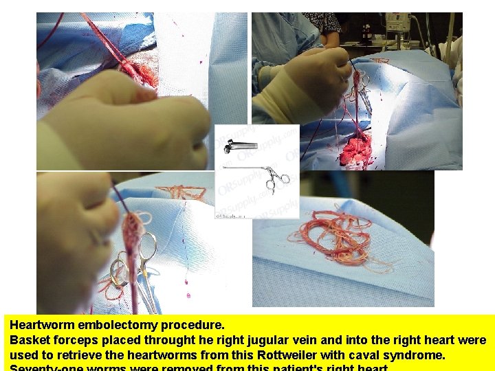 Heartworm embolectomy procedure. Basket forceps placed throught he right jugular vein and into the