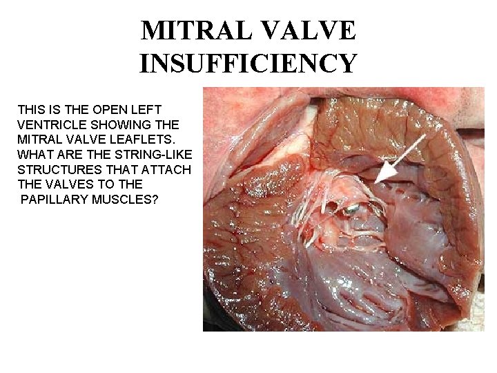 MITRAL VALVE INSUFFICIENCY THIS IS THE OPEN LEFT VENTRICLE SHOWING THE MITRAL VALVE LEAFLETS.