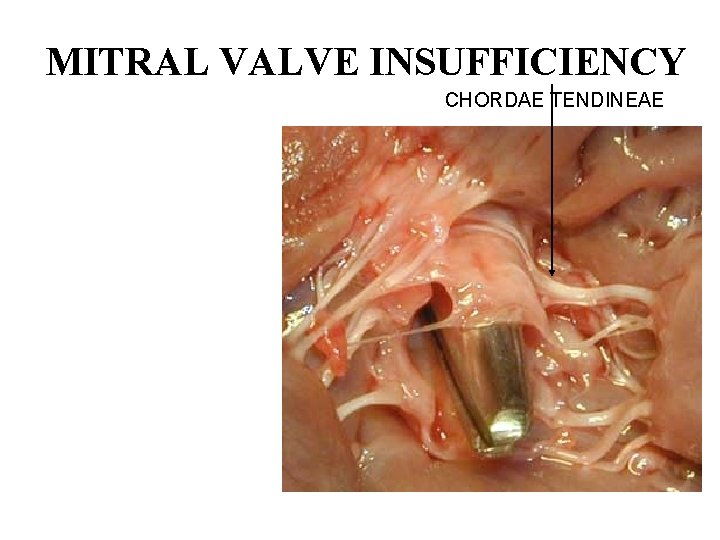 MITRAL VALVE INSUFFICIENCY CHORDAE TENDINEAE 