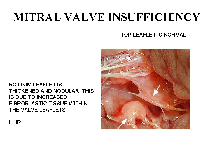 MITRAL VALVE INSUFFICIENCY TOP LEAFLET IS NORMAL BOTTOM LEAFLET IS THICKENED AND NODULAR. THIS