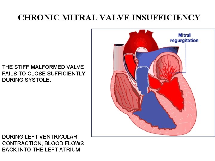 CHRONIC MITRAL VALVE INSUFFICIENCY THE STIFF MALFORMED VALVE FAILS TO CLOSE SUFFICIENTLY DURING SYSTOLE.