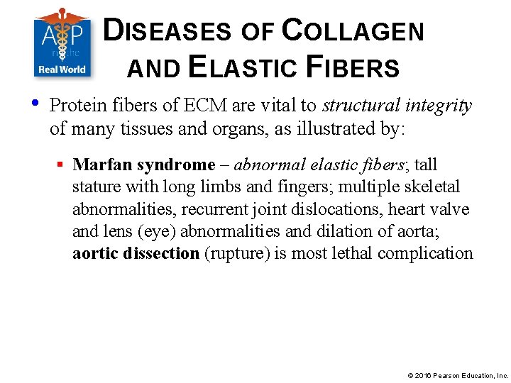 DISEASES OF COLLAGEN AND ELASTIC FIBERS • Protein fibers of ECM are vital to