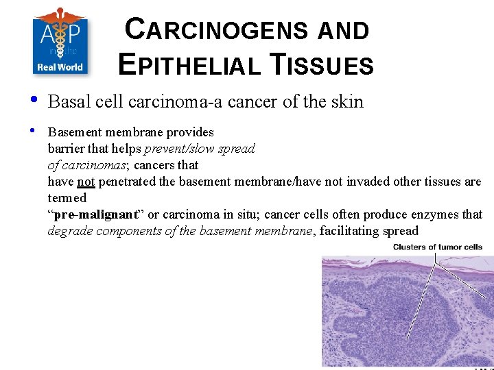 CARCINOGENS AND EPITHELIAL TISSUES • Basal cell carcinoma-a cancer of the skin • Basement