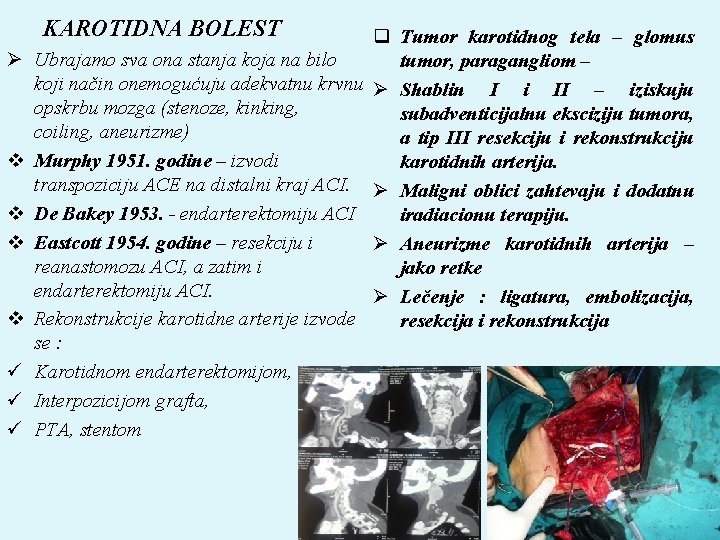 KAROTIDNA BOLEST Ø v v ü ü ü q Tumor karotidnog tela – glomus