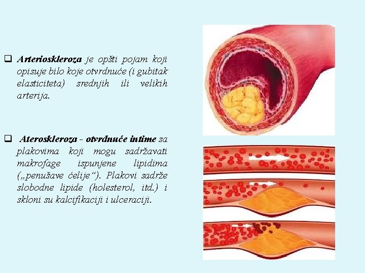 q Arterioskleroza je opšti pojam koji opisuje bilo koje otvrdnuće (i gubitak elasticiteta) srednjih