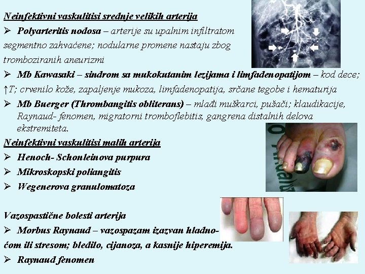 Neinfektivni vaskulitisi srednje velikih arterija Ø Polyarteritis nodosa – arterije su upalnim infiltratom segmentno