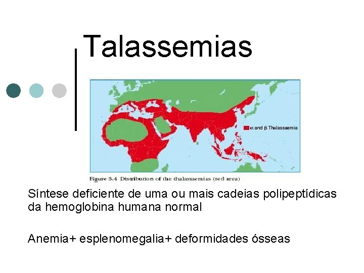 Talassemias Síntese deficiente de uma ou mais cadeias polipeptídicas da hemoglobina humana normal Anemia+
