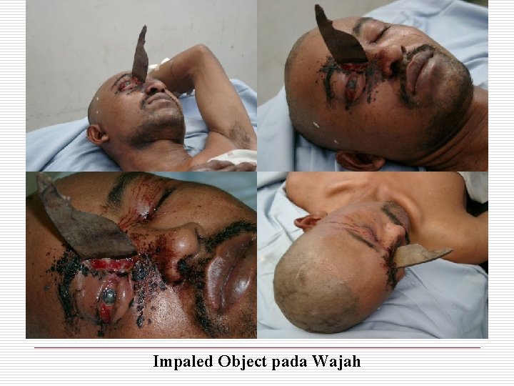 Impaled Object pada Wajah 