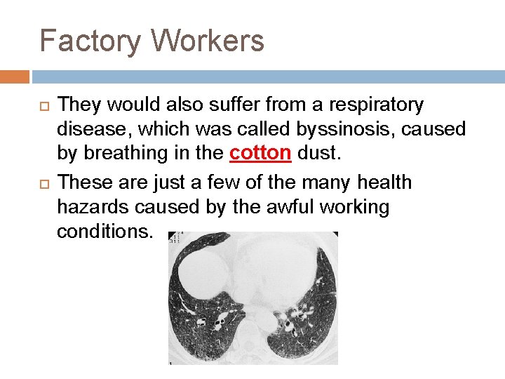 Factory Workers They would also suffer from a respiratory disease, which was called byssinosis,