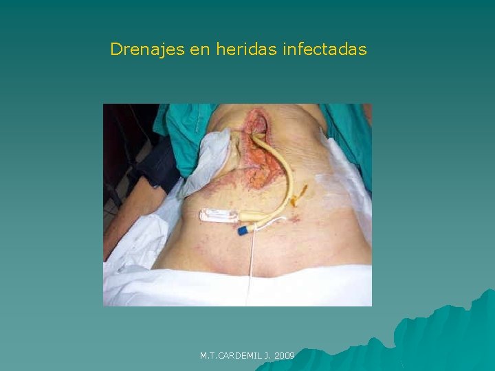 Drenajes en heridas infectadas M. T. CARDEMIL J. 2009 