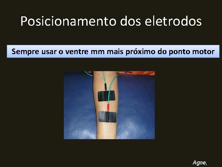 Posicionamento dos eletrodos Sempre usar o ventre mm mais próximo do ponto motor Agne,