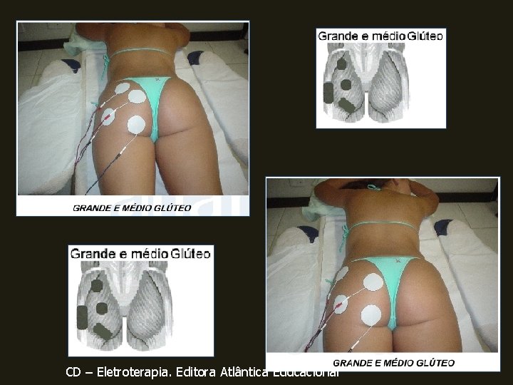 CD – Eletroterapia. Editora Atlântica Educacional 