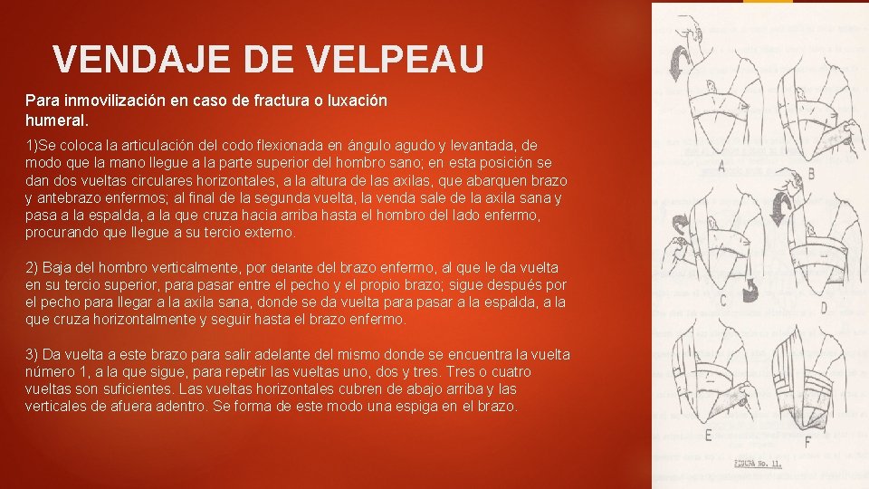 VENDAJE DE VELPEAU Para inmovilización en caso de fractura o luxación humeral. 1)Se coloca VENDAJE DE VELPEAU Para inmovilización en caso de fractura o luxación humeral. 1)Se coloca