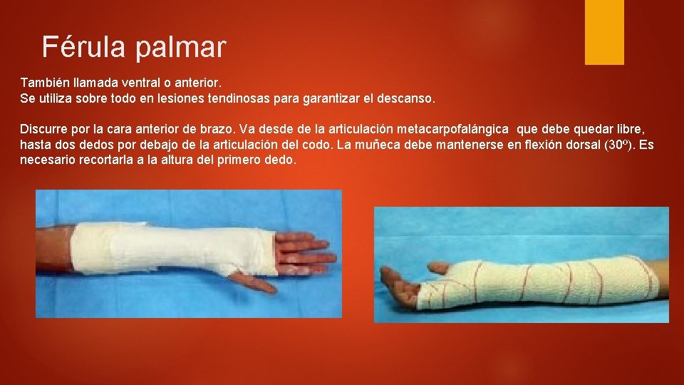 Férula palmar También llamada ventral o anterior. Se utiliza sobre todo en lesiones tendinosas Férula palmar También llamada ventral o anterior. Se utiliza sobre todo en lesiones tendinosas