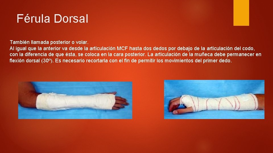 Férula Dorsal También llamada posterior o volar. Al igual que la anterior va desde Férula Dorsal También llamada posterior o volar. Al igual que la anterior va desde