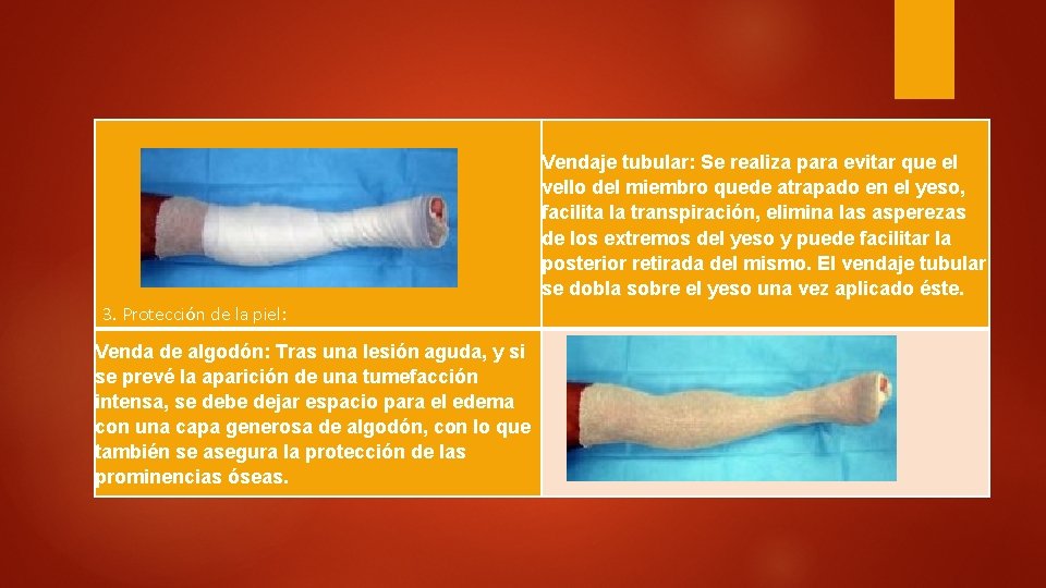 Vendaje tubular: Se realiza para evitar que el vello del miembro quede atrapado en Vendaje tubular: Se realiza para evitar que el vello del miembro quede atrapado en