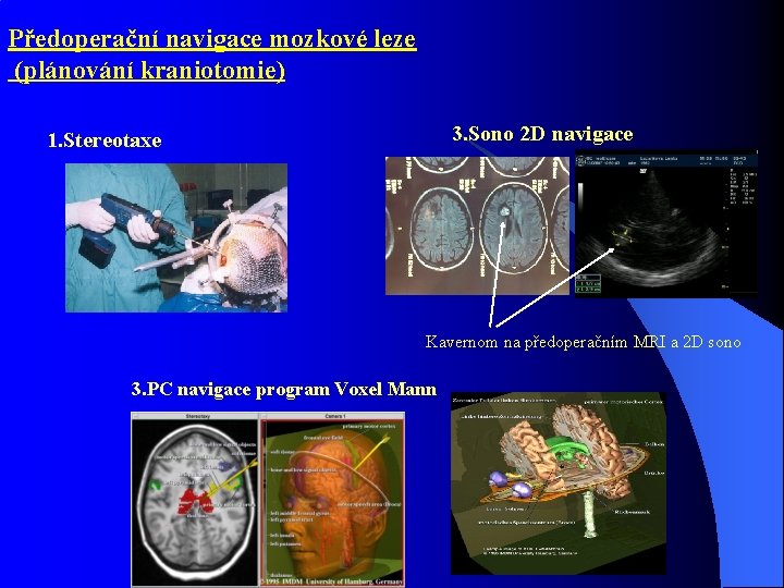 Předoperační navigace mozkové leze (plánování kraniotomie) 3. Sono 2 D navigace 1. Stereotaxe Kavernom