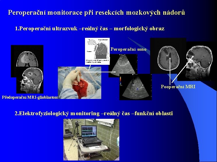 Peroperační monitorace při resekcích mozkových nádorů 1. Peroperační ultrazvuk –reálný čas – morfologický obraz
