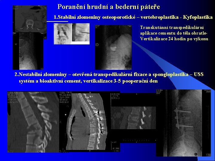 Poranění hrudní a bederní páteře 1. Stabilní zlomeniny osteoporotické – vertebroplastika - Kyfoplastika Transkutánní