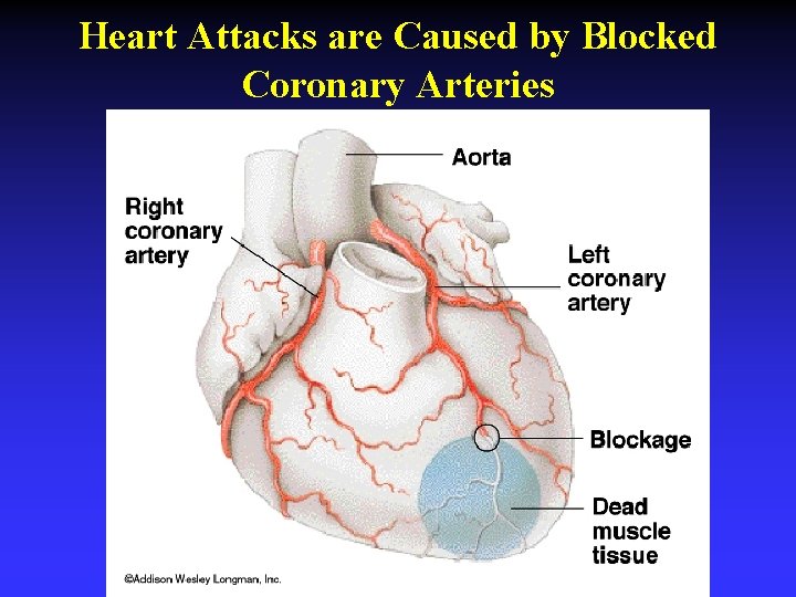 Heart Attacks are Caused by Blocked Coronary Arteries 