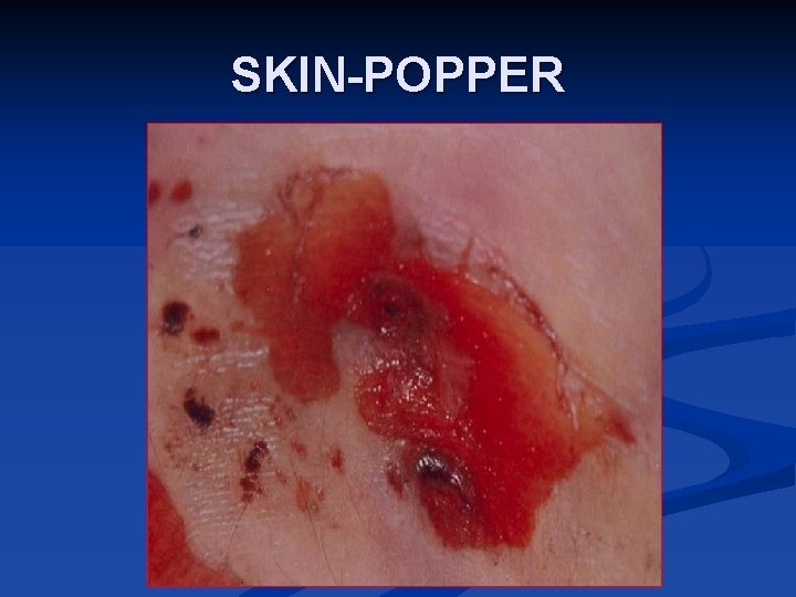 SKIN-POPPER 