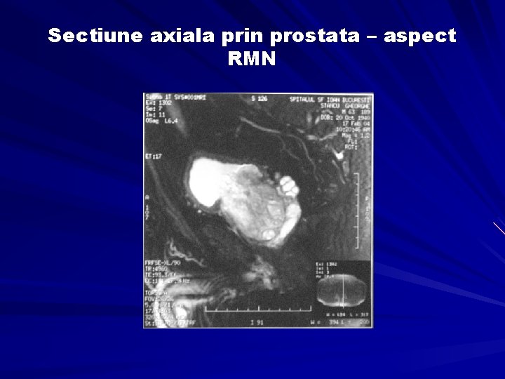 Sectiune axiala prin prostata – aspect RMN 