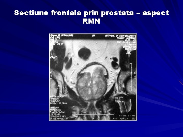 Sectiune frontala prin prostata – aspect RMN 