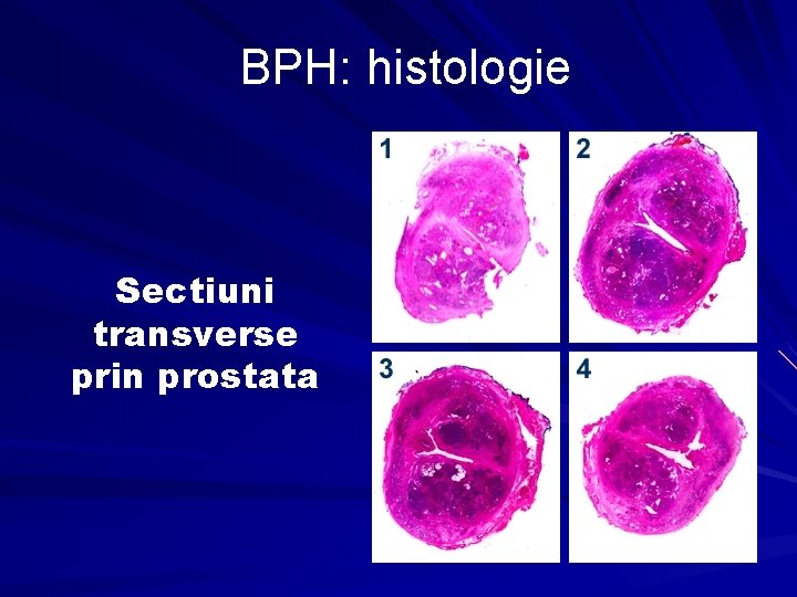 histologie prostatita remedii eficiente pentru tratamentul prostatitei cu remedii populare