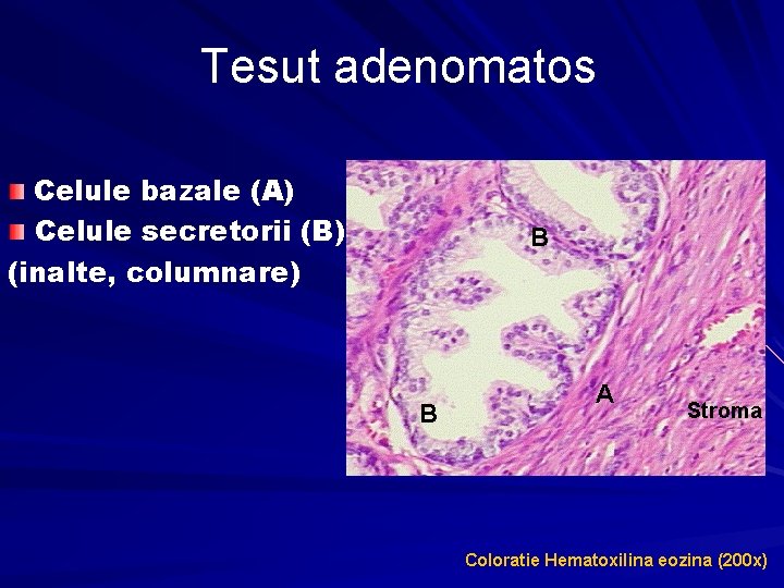 Tesut adenomatos Celule bazale (A) Celule secretorii (B) (inalte, columnare) B B A Stroma