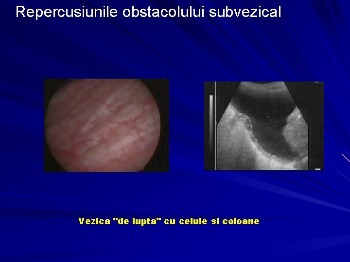 Repercusiunile obstacolului subvezical Vezica "de lupta" cu celule si coloane 