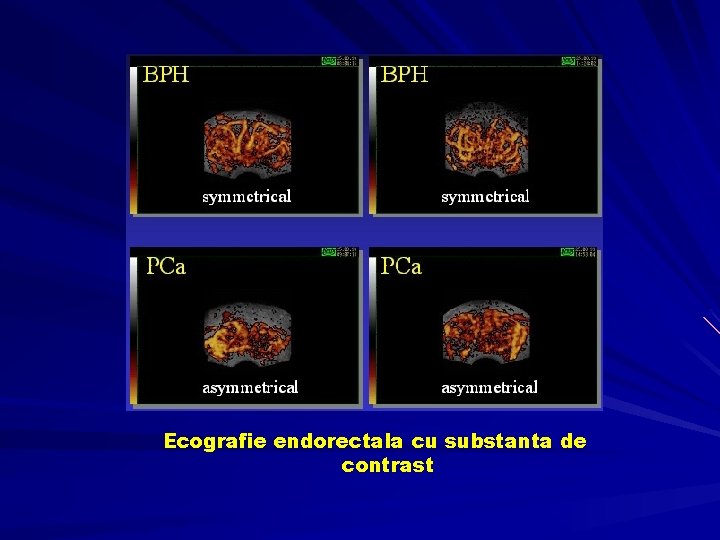 Ecografie endorectala cu substanta de contrast 