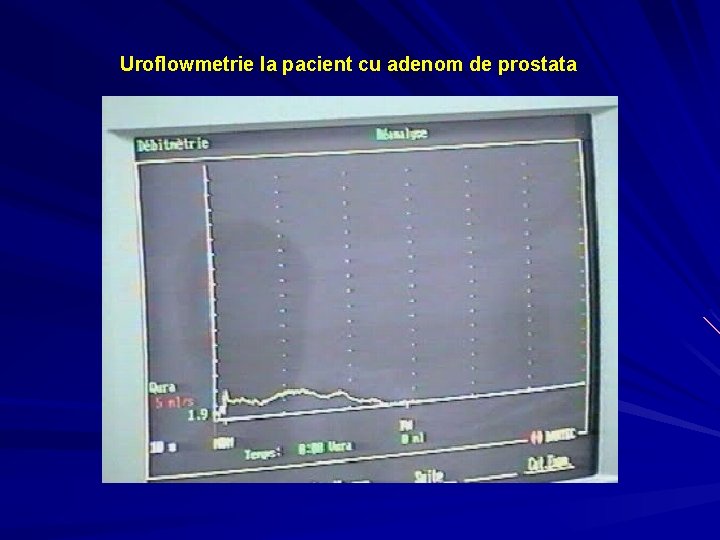 Uroflowmetrie la pacient cu adenom de prostata 