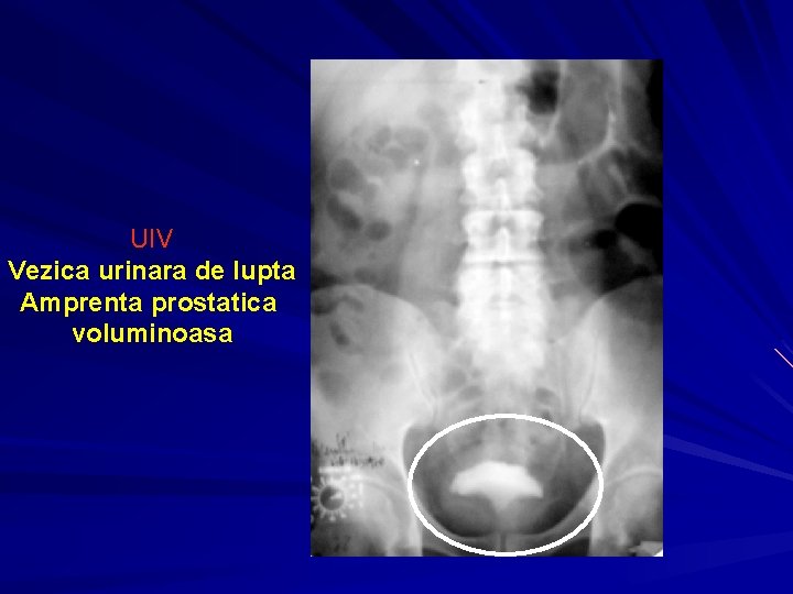 UIV Vezica urinara de lupta Amprenta prostatica voluminoasa 