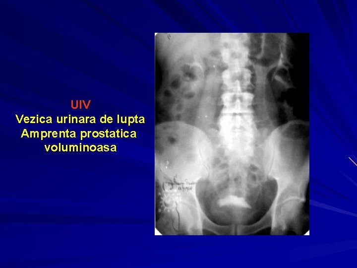 UIV Vezica urinara de lupta Amprenta prostatica voluminoasa 