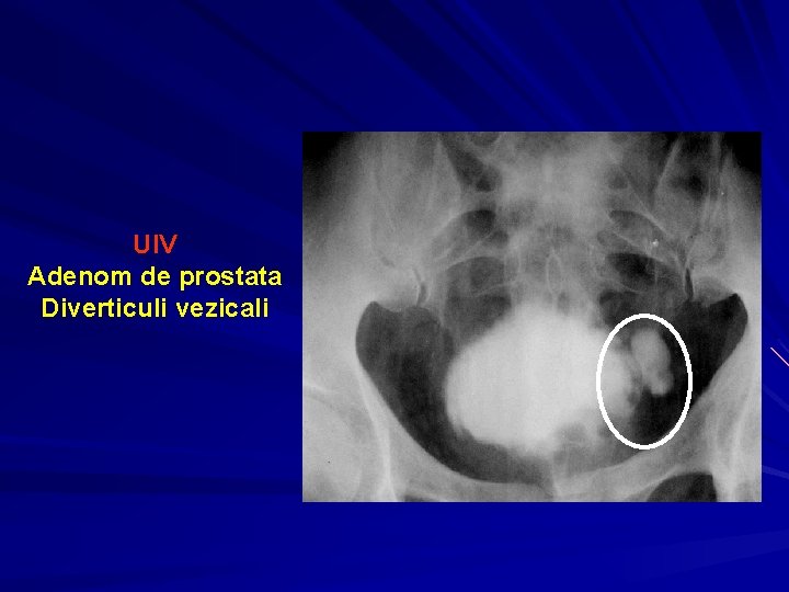 hemoleucograma pentru prostatită sindromul vezicii dureroase