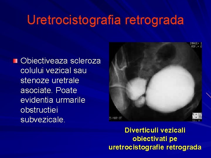 scleroza colului vezicii urinare cu prostatita