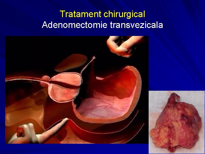 adenomectomie transvezicala