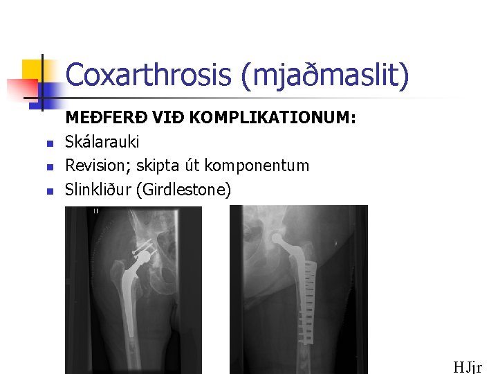 Coxarthrosis (mjaðmaslit) n n n MEÐFERÐ VIÐ KOMPLIKATIONUM: Skálarauki Revision; skipta út komponentum Slinkliður