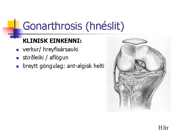 Gonarthrosis (hnéslit) n n n KLINISK EINKENNI: verkur/ hreyfisársauki stirðleiki / aflögun breytt göngulag: