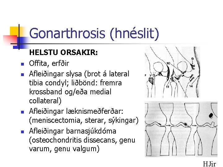 Gonarthrosis (hnéslit) n n HELSTU ORSAKIR: Offita, erfðir Afleiðingar slysa (brot á lateral tibia