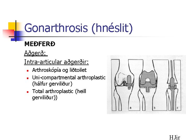 Gonarthrosis (hnéslit) MEÐFERÐ Aðgerð: Intra-articular aðgerðir: n n n Arthroskópía og liðtoilet Uni-compartmental arthroplastic