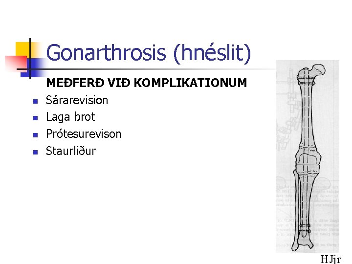 Gonarthrosis (hnéslit) n n MEÐFERÐ VIÐ KOMPLIKATIONUM Sárarevision Laga brot Prótesurevison Staurliður HJjr 