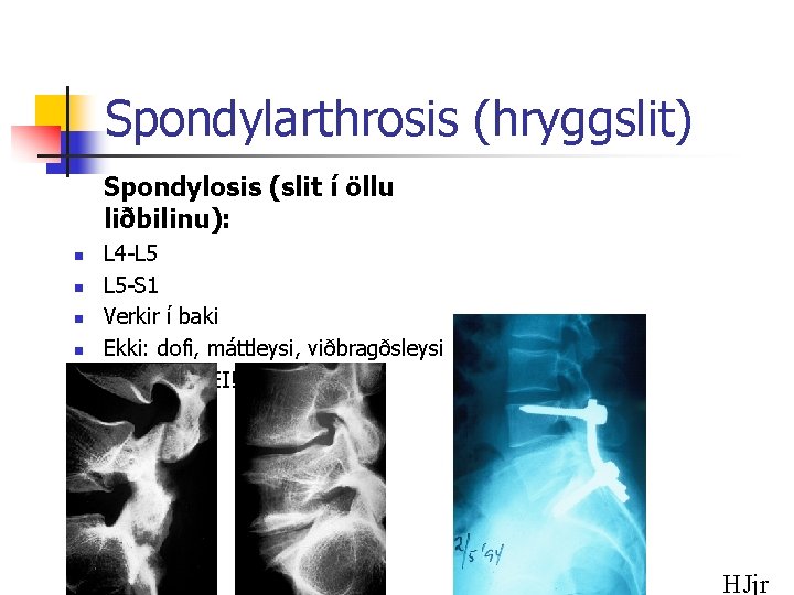 Spondylarthrosis (hryggslit) Spondylosis (slit í öllu liðbilinu): n n n L 4 -L 5