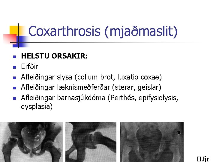 Coxarthrosis (mjaðmaslit) n n n HELSTU ORSAKIR: Erfðir Afleiðingar slysa (collum brot, luxatio coxae)