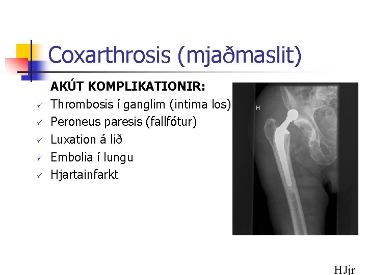 Coxarthrosis (mjaðmaslit) ü ü ü AKÚT KOMPLIKATIONIR: Thrombosis í ganglim (intima los) Peroneus paresis