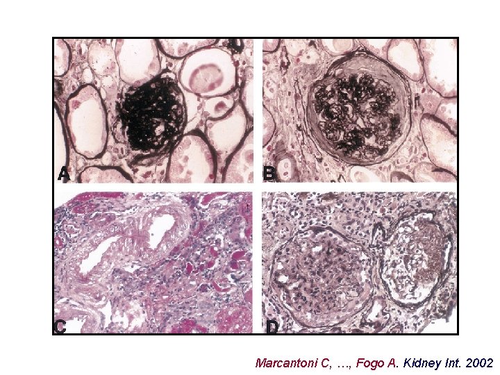 Marcantoni C, …, Fogo A. Kidney Int. 2002 